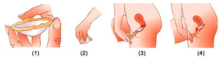 Mise en place du diaphragme ou cape cervicale dans le vagin