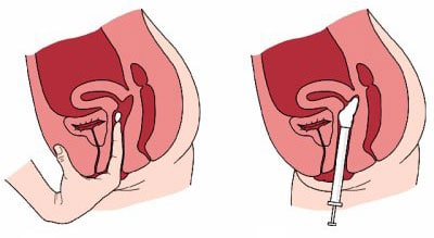 Insertion des spermicides en crème unidose