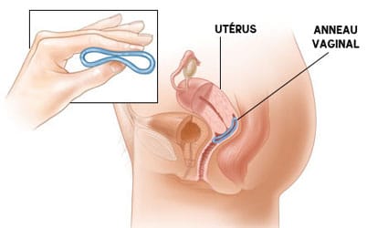 L'anneau une fis en place dans le vagin