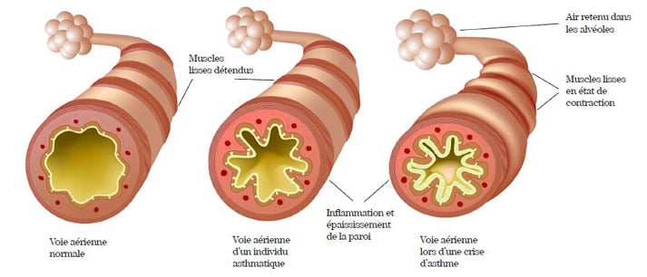 coupe transversale des bronches d'un patient atteint d'asthme