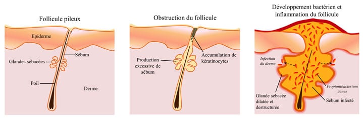 Schéma de la formation des boutons d'acné