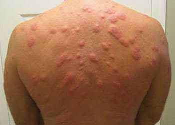Les allergies cutanées les plus courantes: eczéma, urticaire, rash
