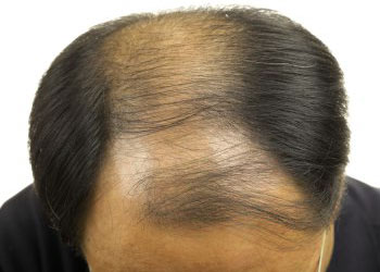 Un comprimé de finasteride par jour pour une repousse des cheveux efficace