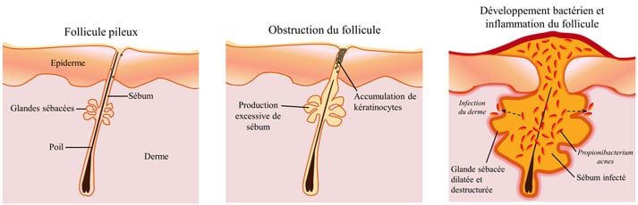 Comment se forment les boutons d'acné ?