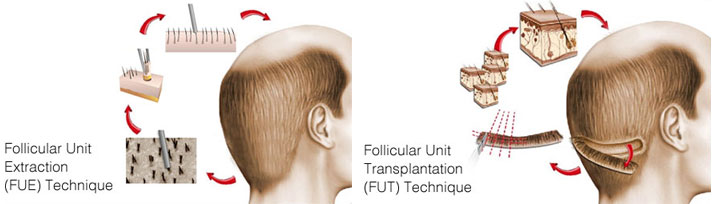 Différences entre greffe FUE et FUT en image