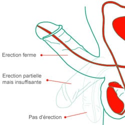 Les troubles de l'érection peuvent se soigner