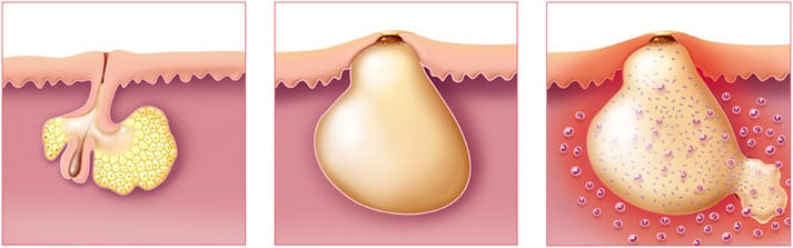 Les différentes étapes de formation d'un bouton d'acné