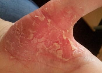 Photo de la main d'une personne touchée par l'eczéma