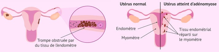 Comment gérer endométriose et grossesse ?
