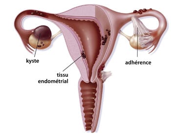 illustration de l'endométriose